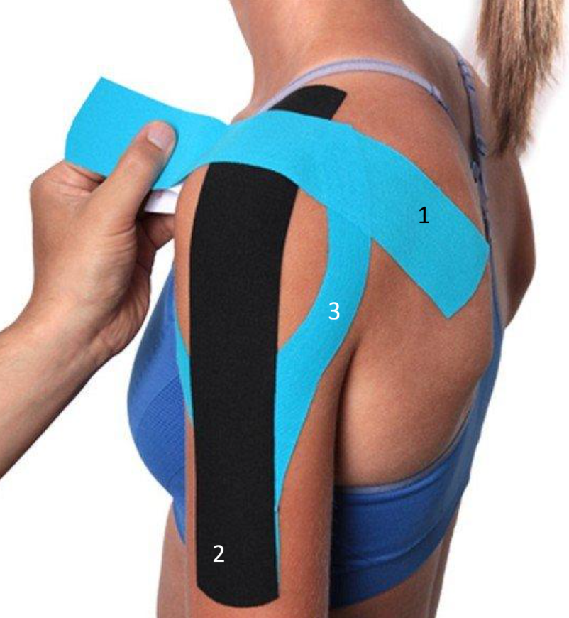 Нюансы при тейпирвоании импиджмент синдрома плечевого сустава