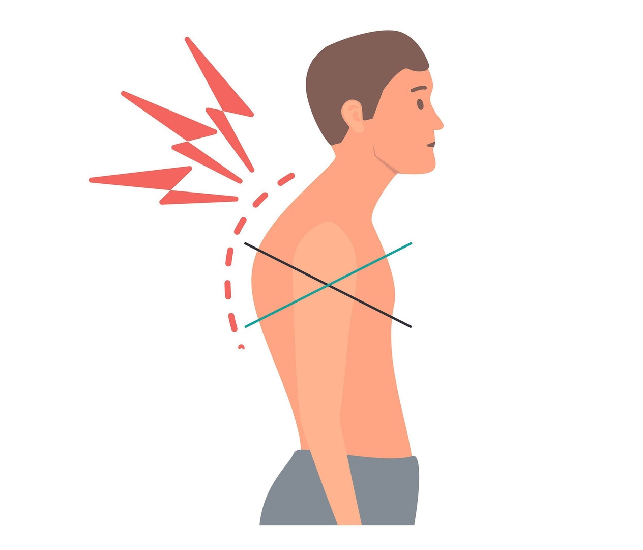 Фито-поддержка при болях между лопатками, крыловидных лопатках и ощущении 