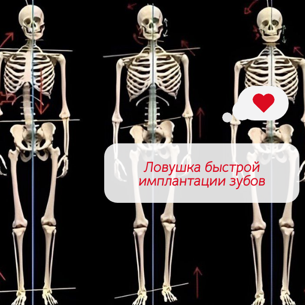 Ловушка быстрой имплантации зубов